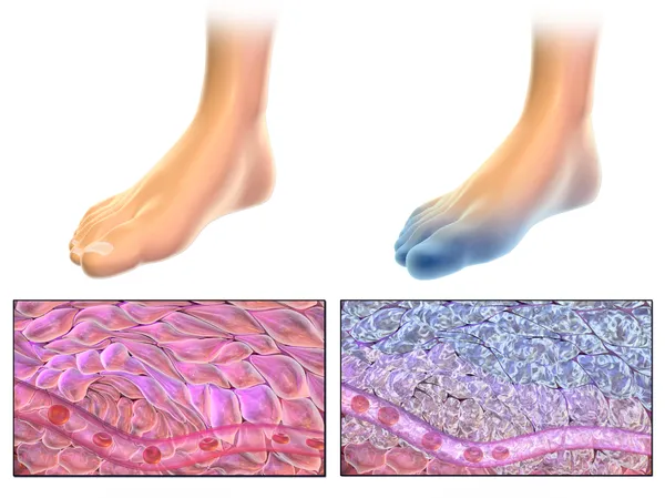 UofL Health reports 23 frostbite patients as doctors outline prevention, warning signs and first-aid steps